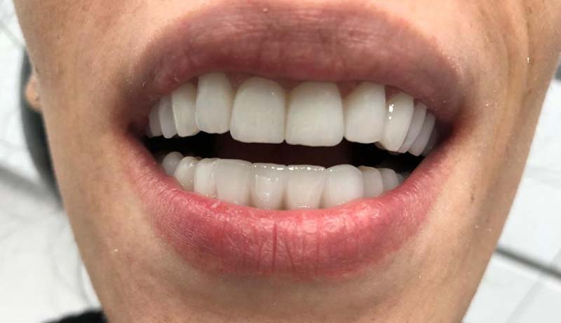 Cazul 01 — tratament estetic Dental Endorphine Brăila, după