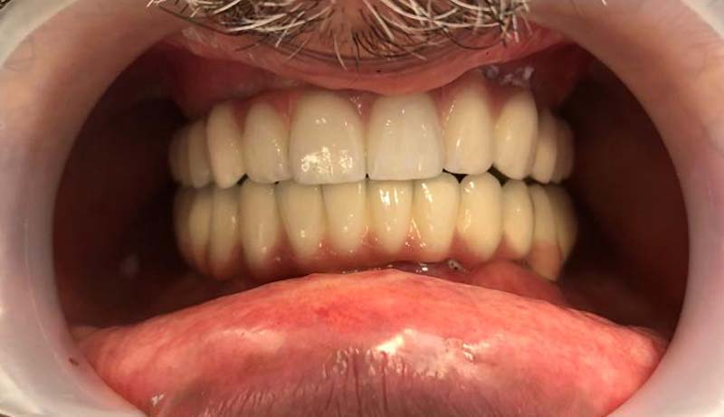 Cazul 02 — tratament estetic Dental Endorphine Brăila, după