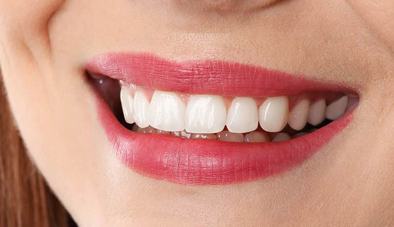 Cazul 03 — tratament estetic Dental Endorphine Brăila, după
