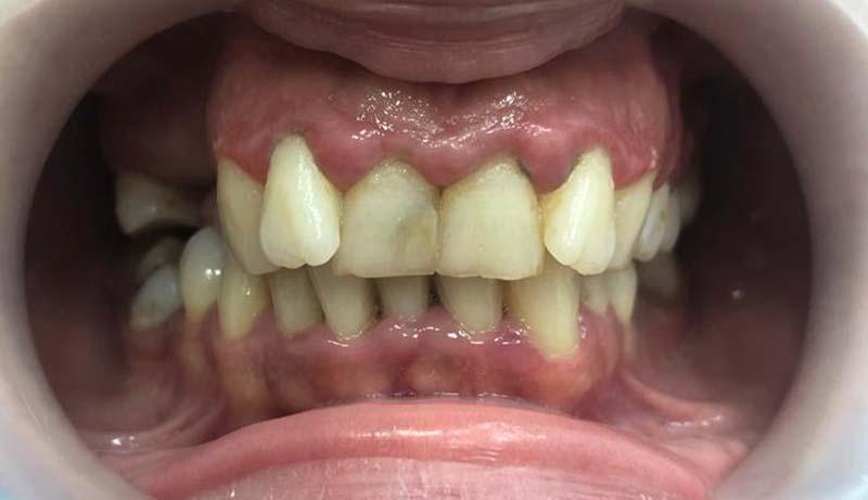 Cazul 01 — tratament estetic Dental Endorphine Brăila, înainte