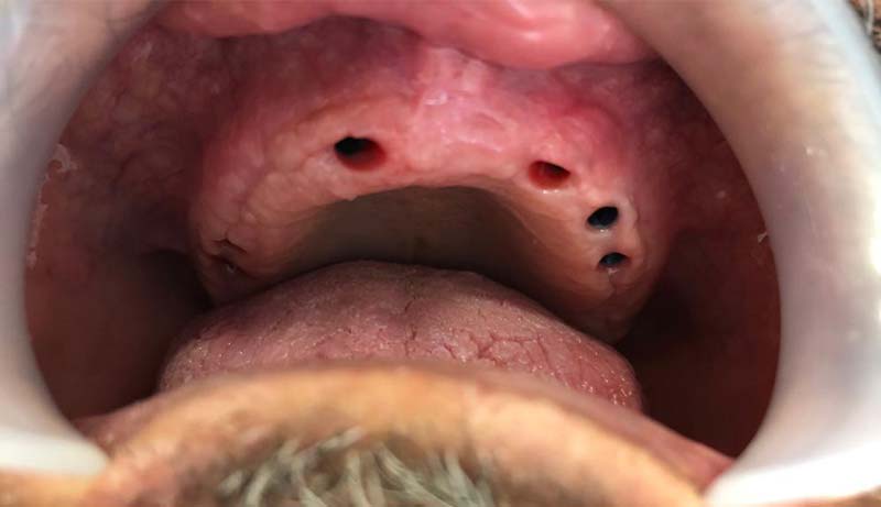 Cazul 02 — tratament estetic Dental Endorphine Brăila, înainte
