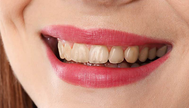 Cazul 03 — tratament estetic Dental Endorphine Brăila, înainte